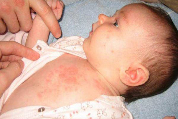   حساسیت پوستی نوزاد به شوینده‌ها