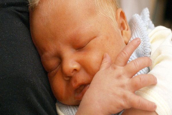 عوامل تشدیدکننده ابتلا به زردی در نوزاد