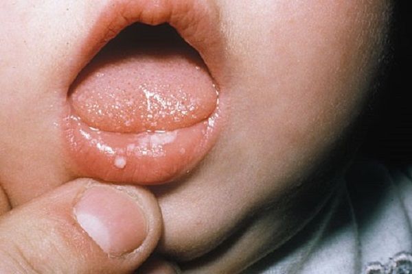 عفونت‌های قارچی پوست کودک