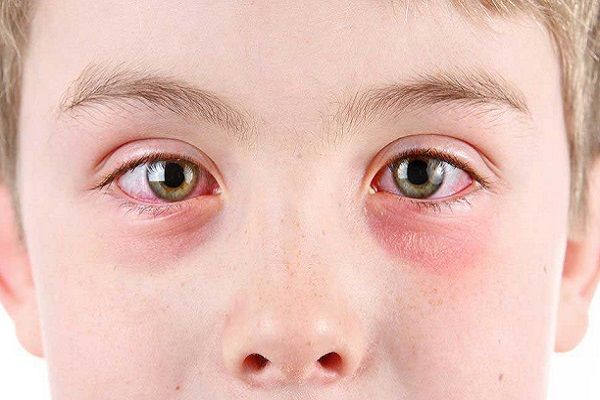 آیا التهاب ملتحمه چشم مسری است؟