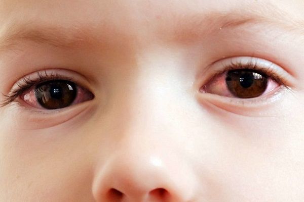 مراقبت‌های لازم در التهاب ملتحمه چشم آلرژیک