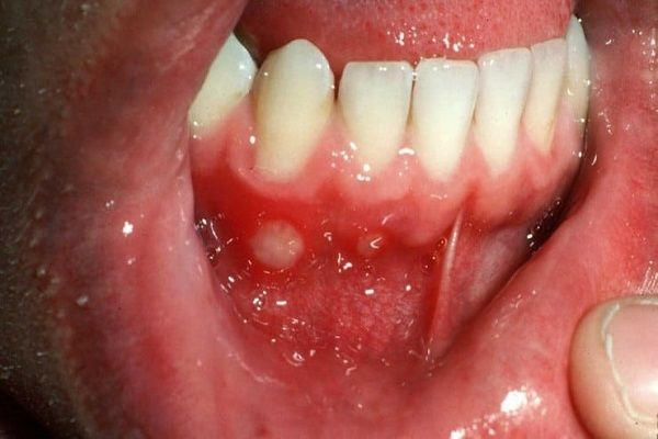 علت آفت دهان و لثه در کودکان