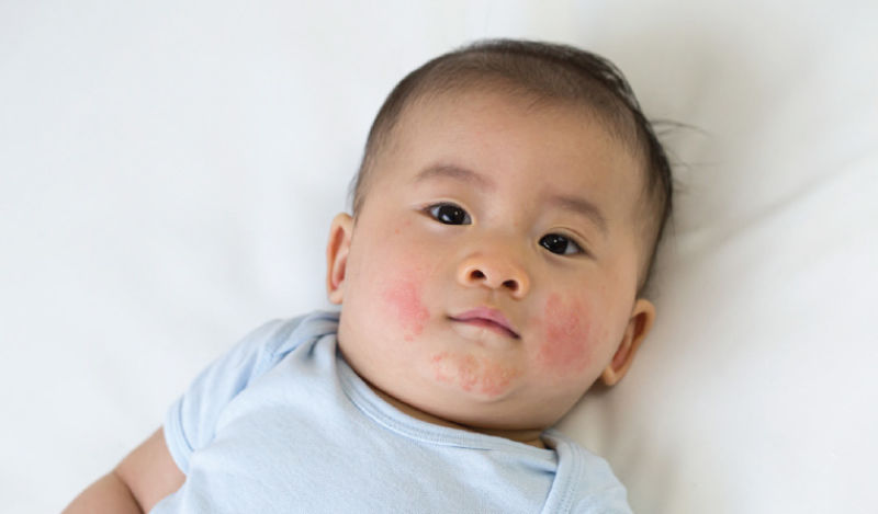 علائم حساسیت حریره بادام در نوزاد