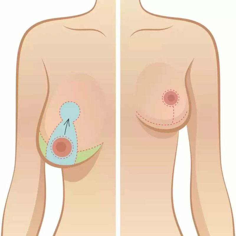 درمان افتادگی سینه بعد از شیردهی