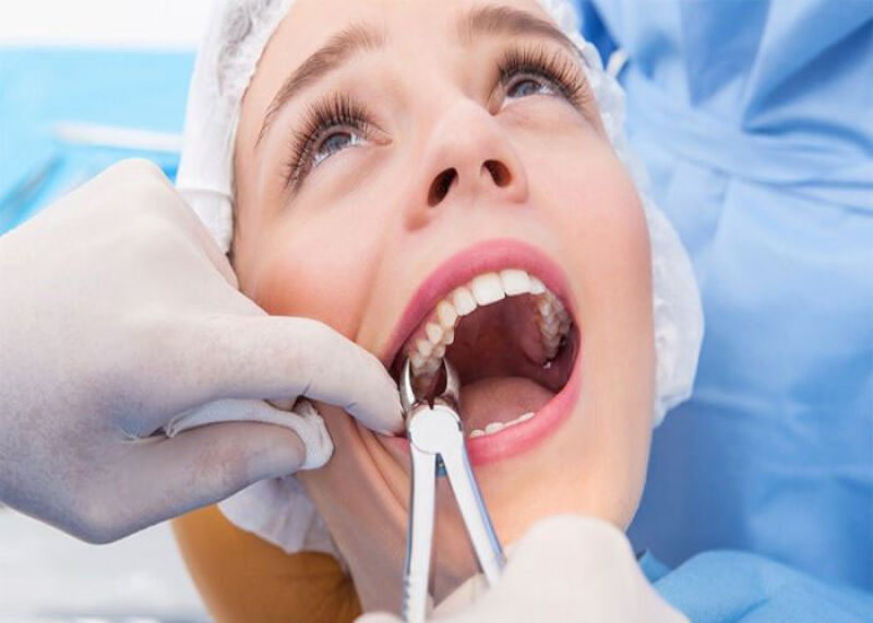برای عفونت دندان عقل بعد از کشیدن دندان چه باید کرد؟