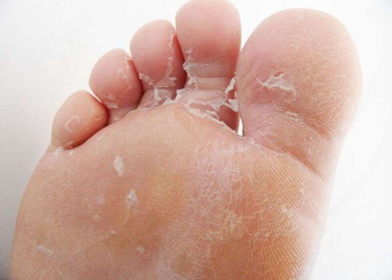درمان پوست پوست شدن کف پا