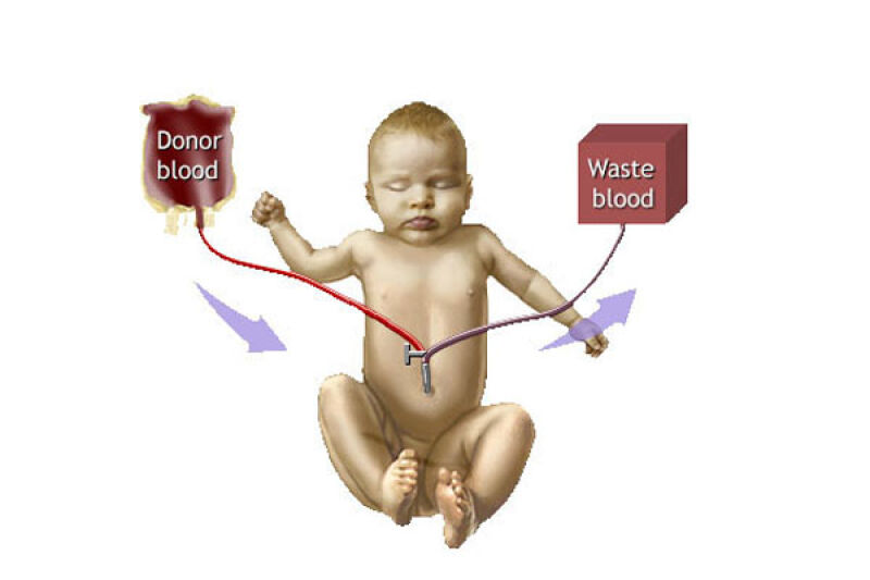 تعویض خون نوزاد