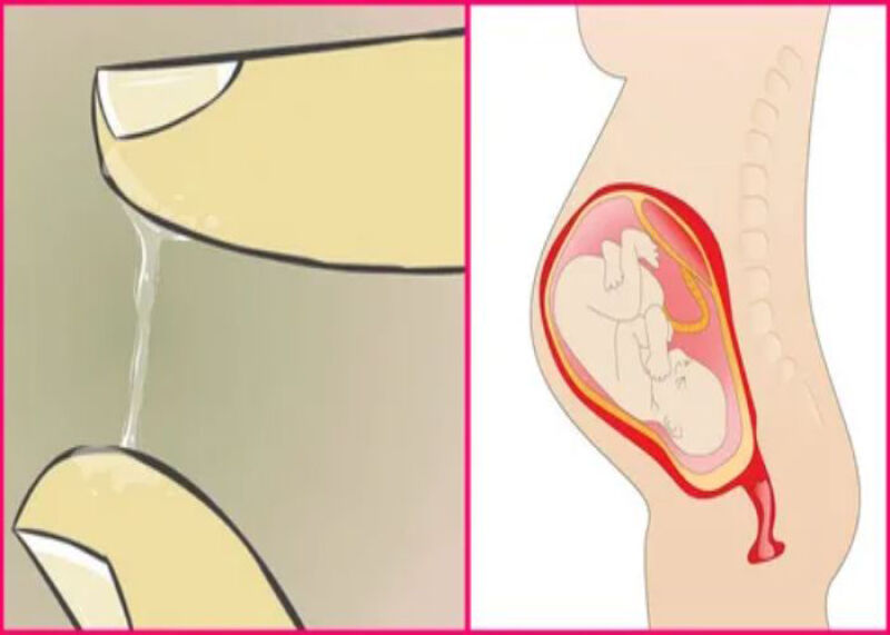 علت ریزش آب از واژن در بارداری