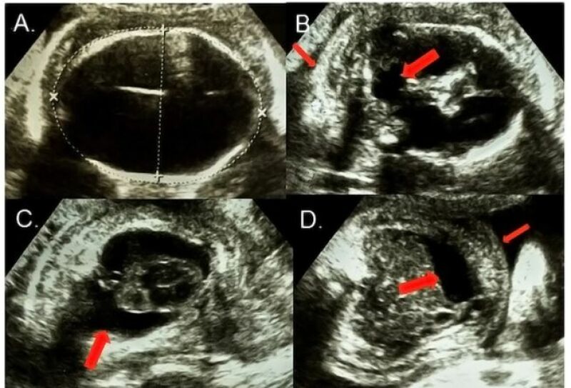 درمان هیدروپس فتالیس قبل از تولد