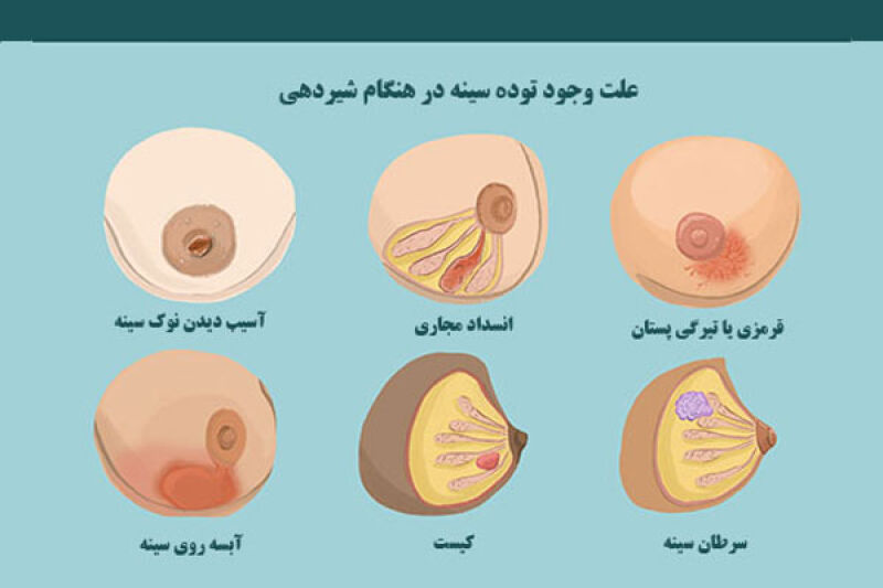سرطان سینه در دوران شیردهی