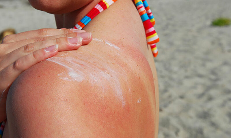 درمان آفتاب سوختگی و تیرگی پوست طب سنتی