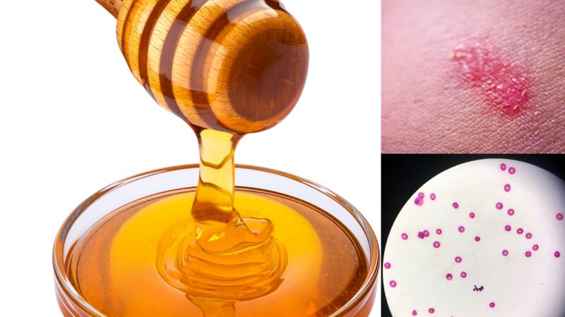 عسل و درمان قارچ پوستی