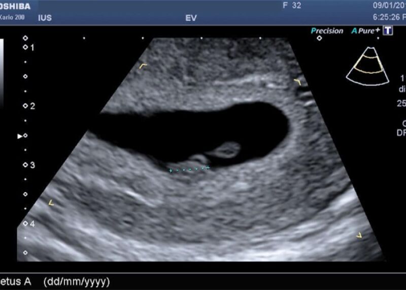 فرایند انجام سونوگرافی هفته ششم بارداری