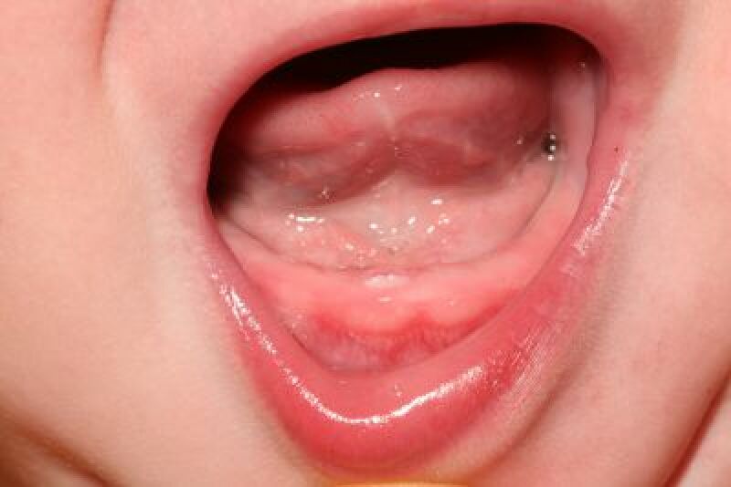 لثه نوزاد هنگام دندان درآوردن