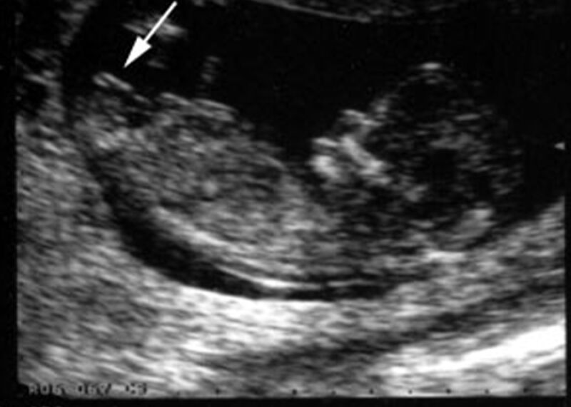 تفاوت جنین دختر و پسر در سونوگرافی هفته ۱۲