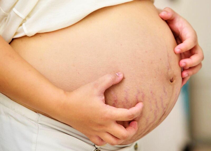 درمان کلستاز بارداری