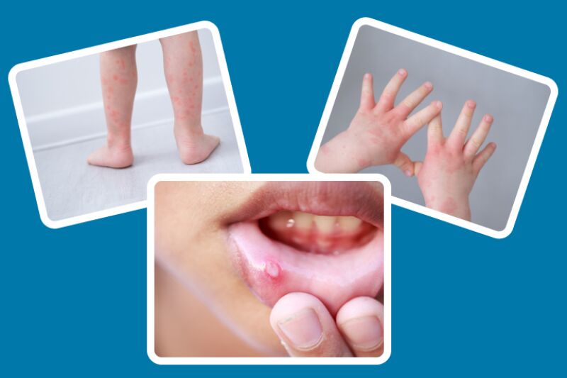 عکس بیماری دست و پا دهان در کودکان