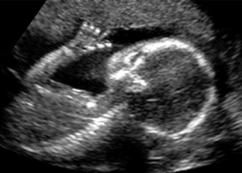 علت بزرگ شدن سر جنین در بارداری