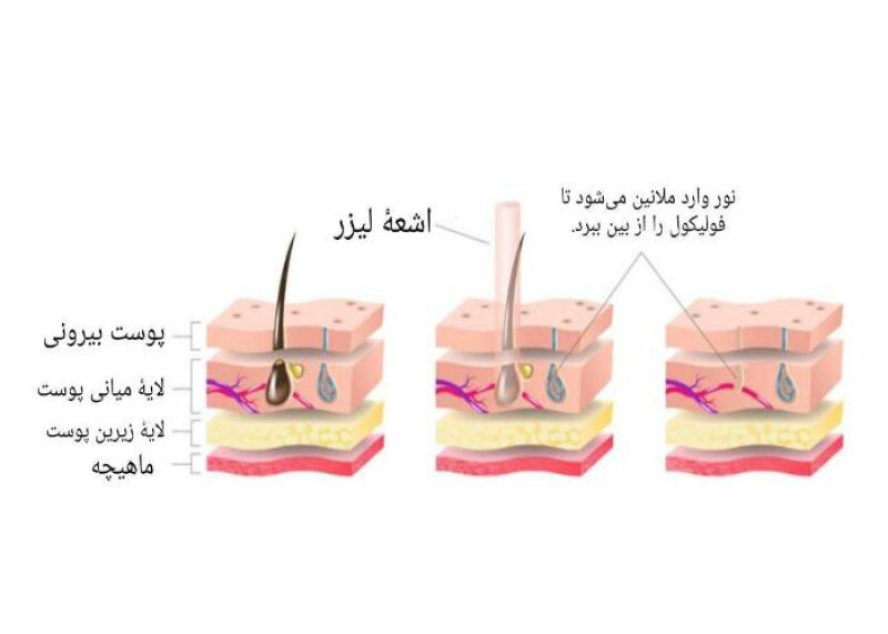 شیوۀ عملکرد لیزر موهای زائد و رابطۀ آن با نازایی