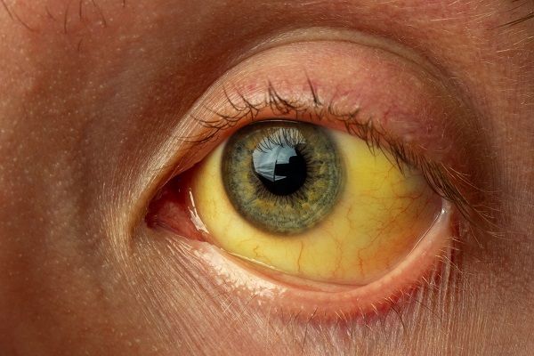 علت زردی چشم در کودکان