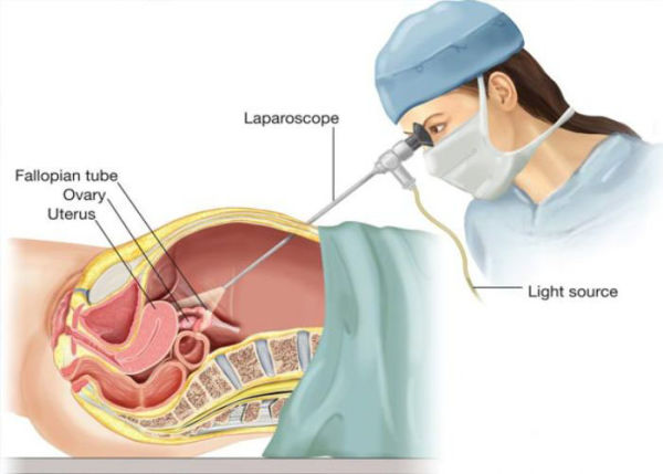 عوارض لاپاراسکوپی در بارداری