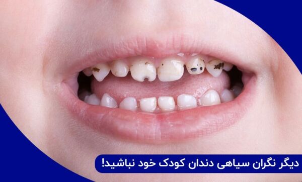 مادران دیگر نگران سیاهی دندان کودک خود نباشید