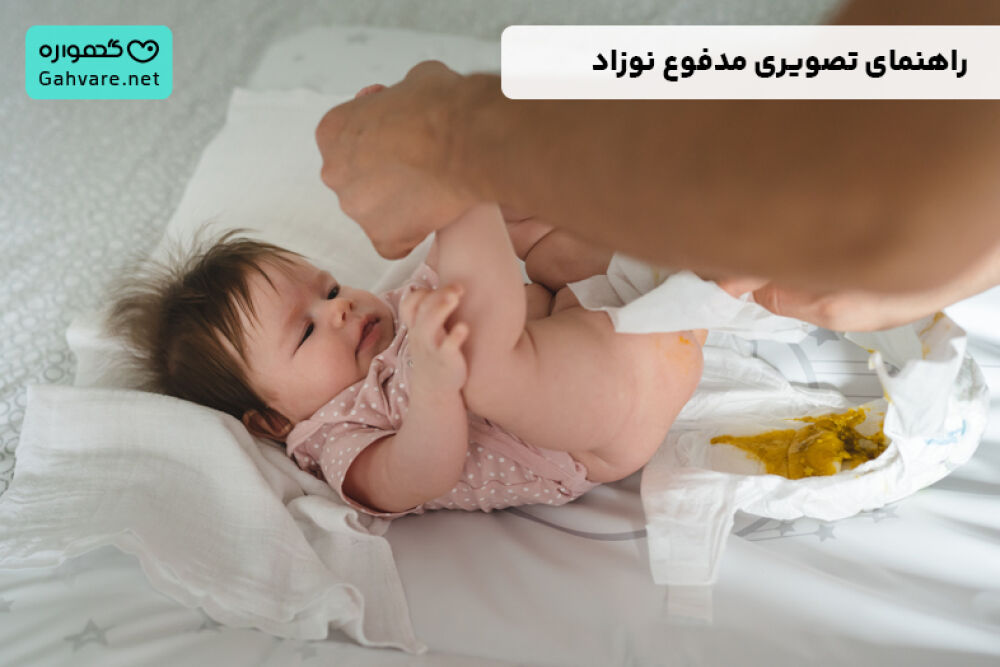 انواع شکل مدفوع نوزادان