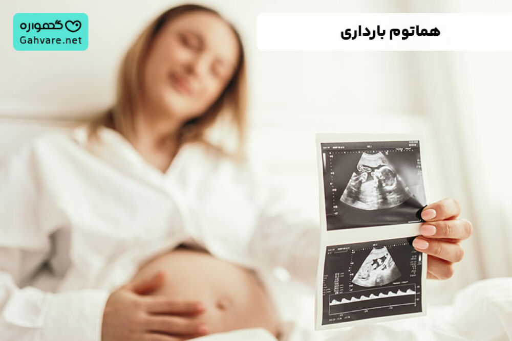 هماتوم بارداری