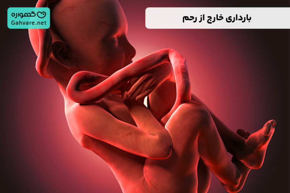 بارداری خارج از رحم