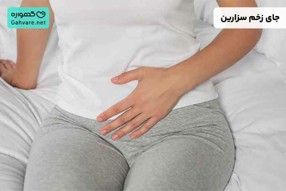 جای زخم سزارین