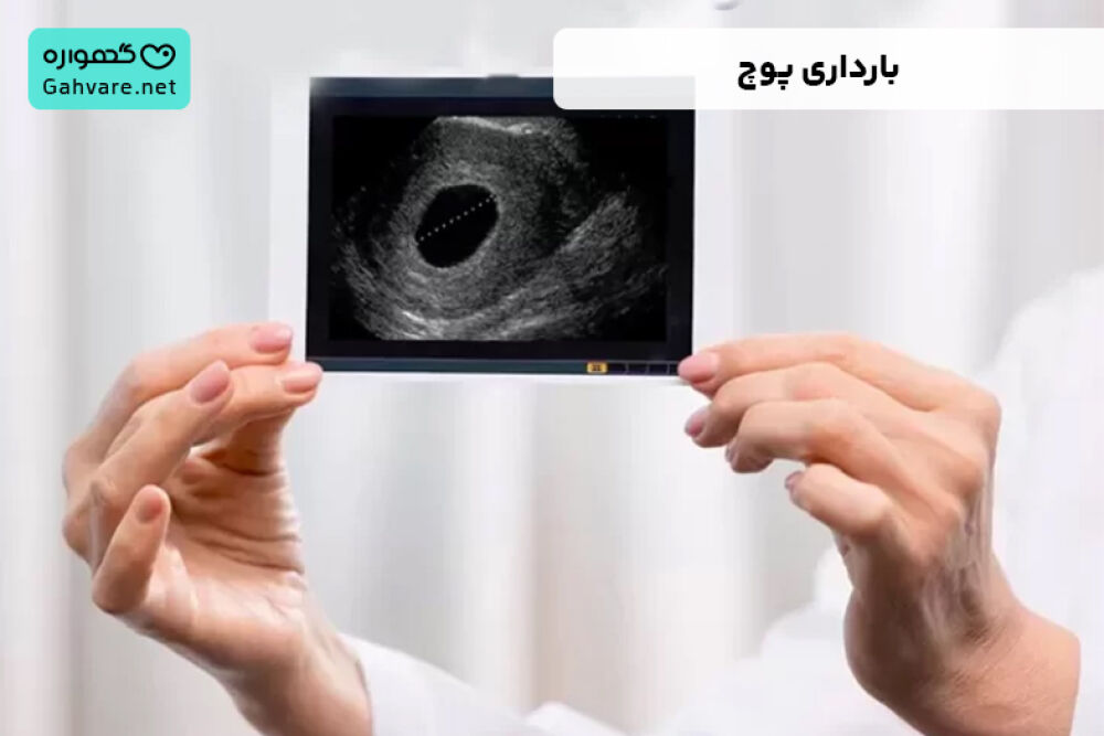 بارداری پوچ