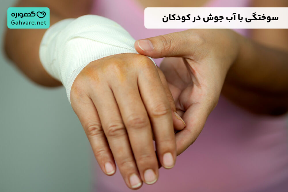 درمان سوختگی با آب جوش در کودکان