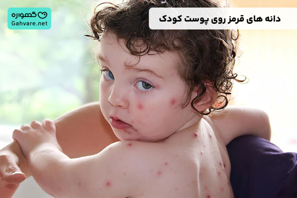 دانه های قرمز روی پوست کودک همراه خارش