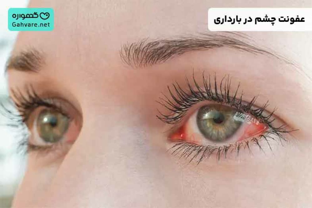 عفونت چشم در بارداری