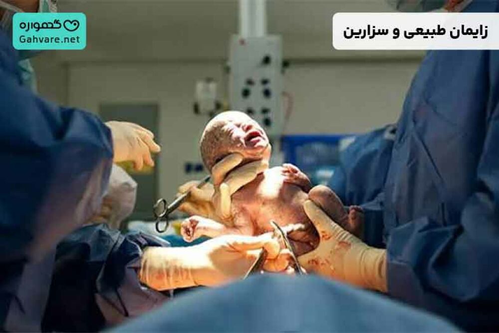 زایمان طبیعی و سزارین