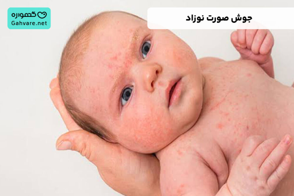 درمان جوش صورت نوزاد
