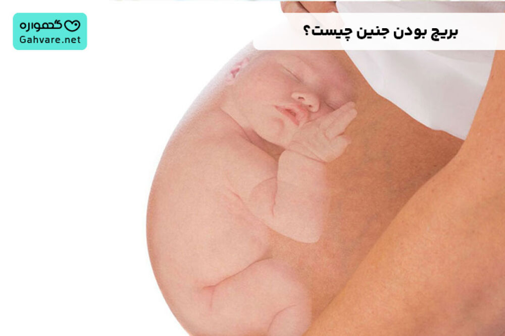 بریچ بودن جنین