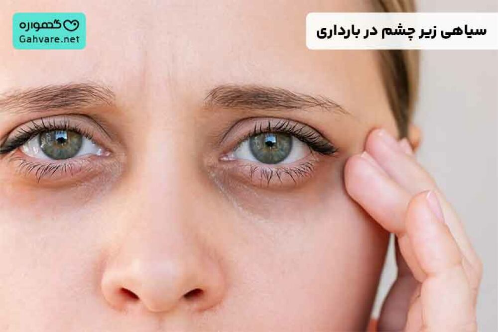سیاهی زیر چشم در بارداری