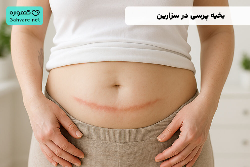 بخیه پرسی در سزارین