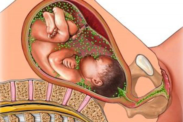علائم سیفلیس در بارداری