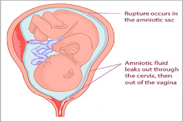 علائم سوراخ شدن کیسه آب در بارداری