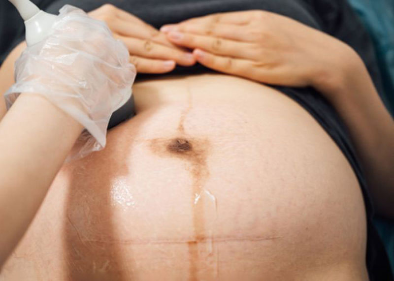 سونوگرافی چسبندگی رحم در بارداری چگونه انجام می‌شود؟