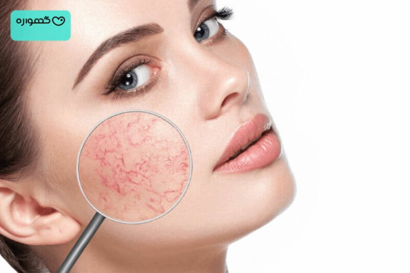 رگ های عنکبوتی در بارداری