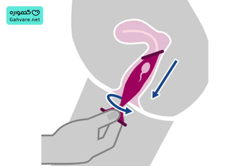 روش خارج کردن کاندوم زنانه از واژن