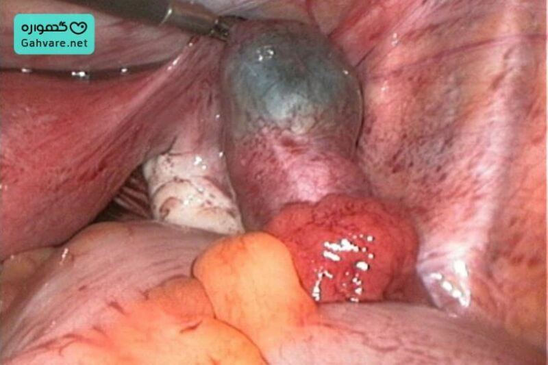 تیتر بارداری در حاملگی خارج از رحمی