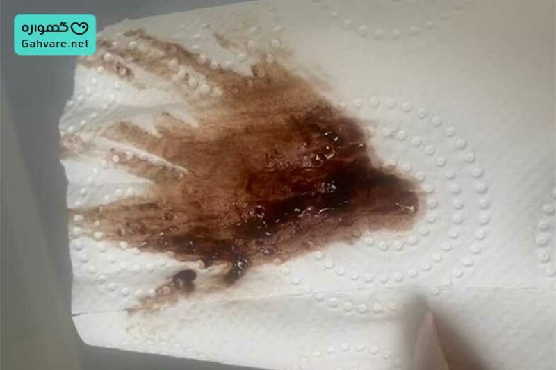 عکس لکه بینی قهوه ای در بارداری