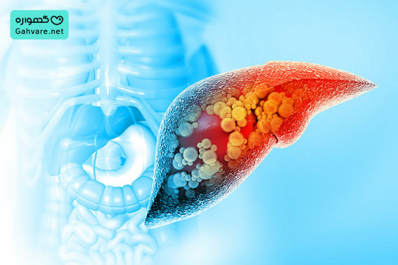 کبد چرب در بارداری