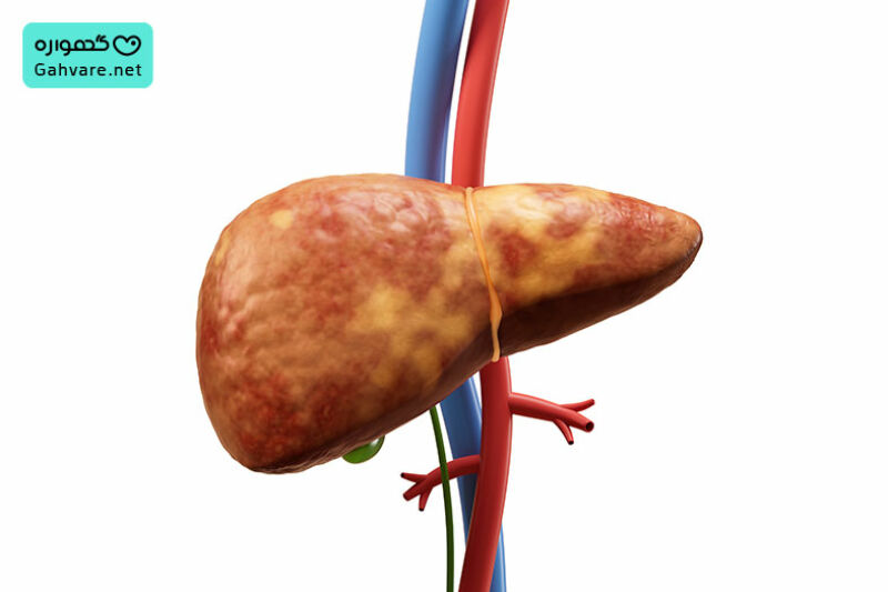 تغذیه برای کبد چرب در بارداری