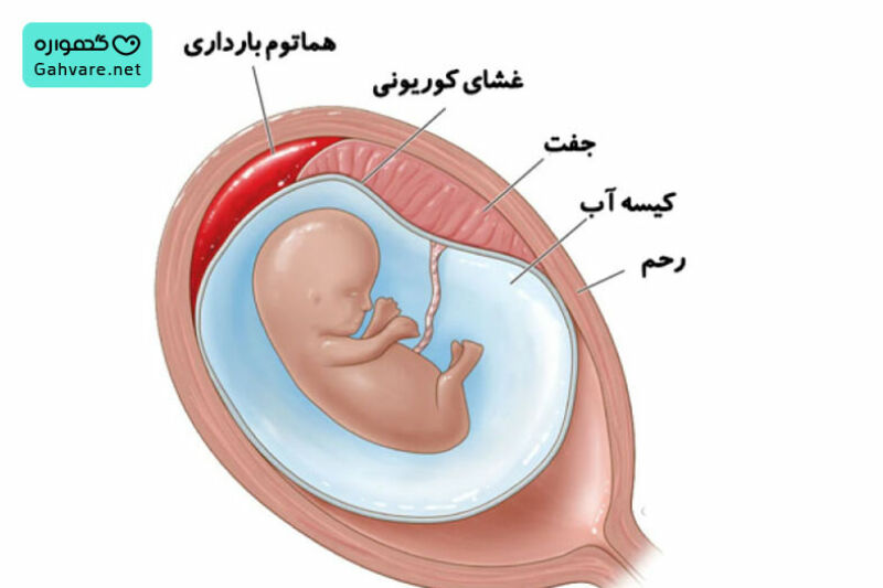 هماتوم در بارداری
