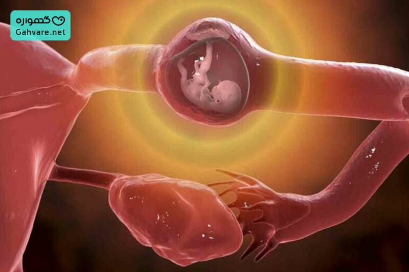 بارداری خارج از رحم کجا اتفاق می افتد؟